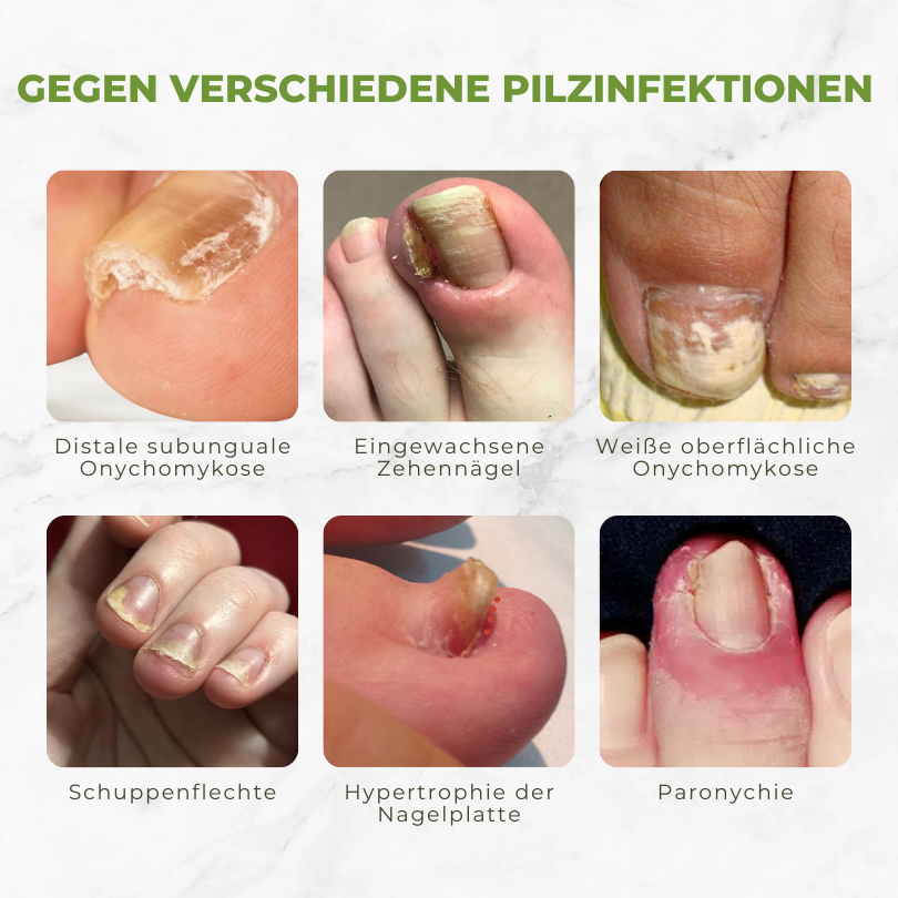 Körömkezelő olaj méhméreggel